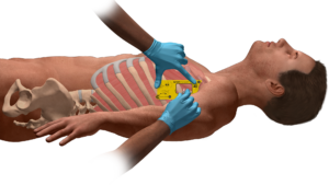 Sam medical sam thorasite